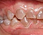Наследственные поражения тканей зубов у детей синдром стентона капдепона thumbnail