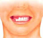 Частичная адентия зубов код мкб thumbnail