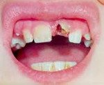 Травмы зубов