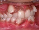 K07.3 Аномалии положения зубов