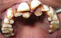 K07.3 Аномалии положения зубов