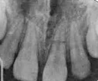 Продольный перелом зуба мкб thumbnail