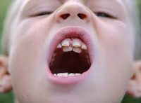K00.1 Сверхкомплектные зубы