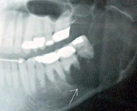 Код мкб рак нижней челюсти thumbnail