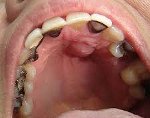 K12.2 Флегмона и абсцесс полости рта