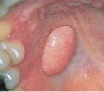 Фиброма полости рта