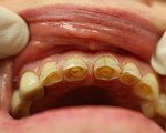 Код мкб 10 болезни твердых тканей зуба thumbnail