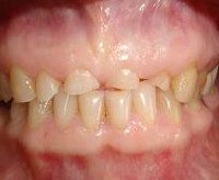 Патологическая стираемость зубов
