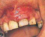 Рак слизистой альвеолярного отростка нижней челюсти код мкб 10 thumbnail