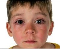 Аллергический поллиноз код по мкб 10 у детей thumbnail