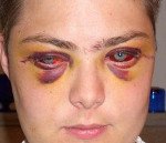 Травма глаз и глазницы. Ушиб глазного яблока и тканей глазницы III-IV степени thumbnail