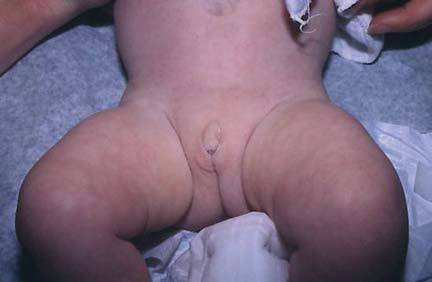 Гипертрофия клитора у новорожденного при адреногенитальном синдроме
