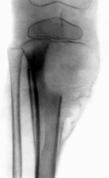 Аневризмальная киста большеберцовой кости (рентгенограмма)