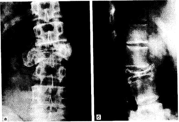 Аневризмальная киста II поясничного позвонка (рентгенограмма)