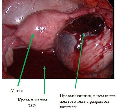 Апоплексия правого яичника, внутрибрюшное кровотечение