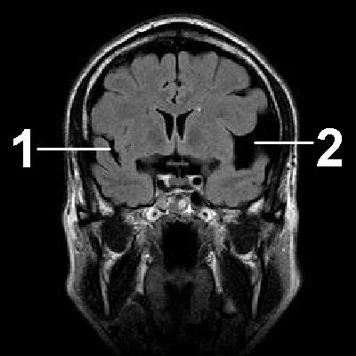 Порэнцефалическая киста головного мозга код мкб thumbnail