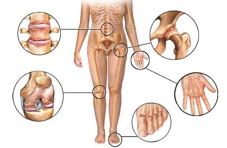 Поражение различных суставов при артрите