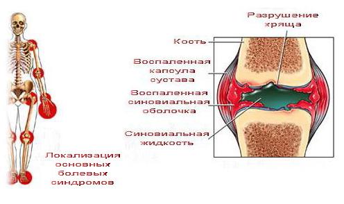 Локализация болевого синдрома при артрите