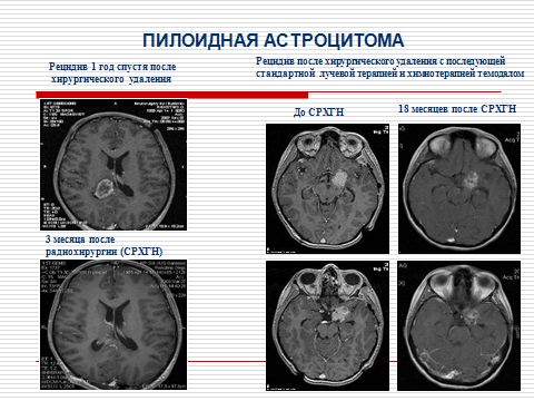 Астроцитома спинного мозга код по мкб thumbnail