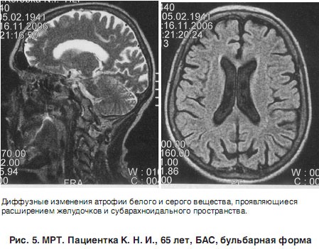 МРТ-снимок головного мозга пациентки с БАС
