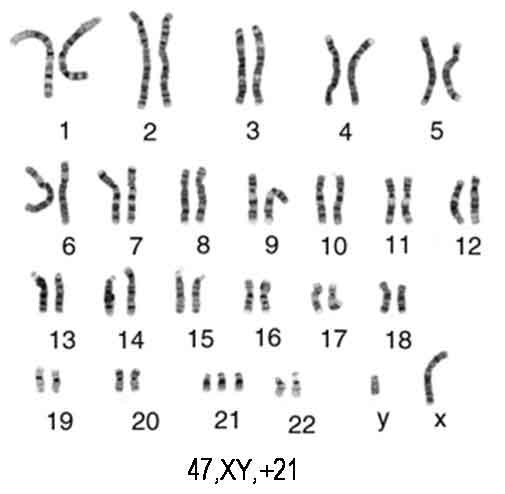 Трисомия по 21-й хромосоме
