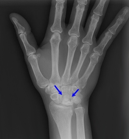 Рентгеннограмма при болезни Кинбека
