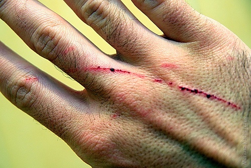 Повреждения кожи при болезни кошачьих царапин