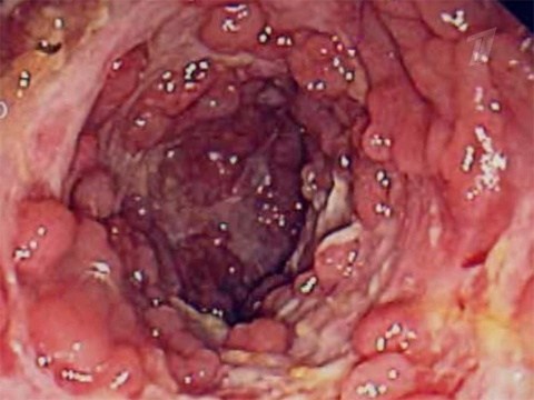 Слизистая оболочка кишки при болезни Крона на эндоскопическом обследовании