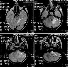 Поражение центральной нервной системы при болезни Лайма (снимки МРТ)
