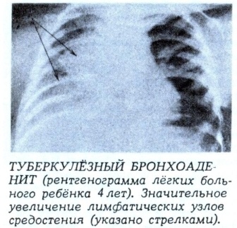 Туберкулезный бронхоаденит