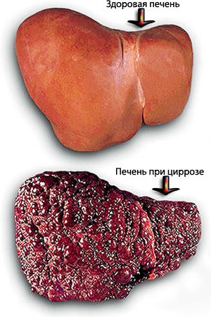 Цирроз печени код диагноза thumbnail
