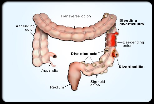 Анатомическое расположение дивертикулов кишечника