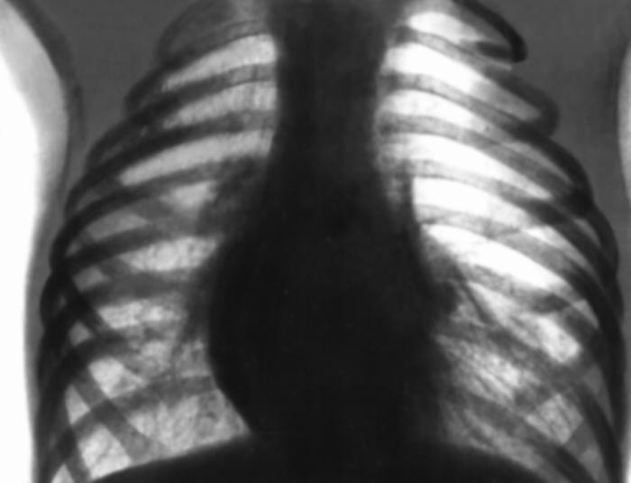Эмфизема легких на рентгенограмме