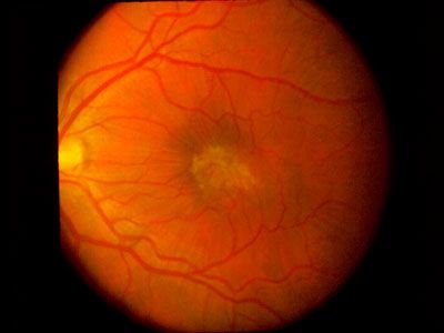 Эпиретинальная мембрана при осмотре глазного дна