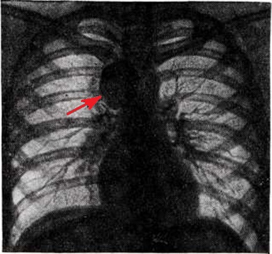 Ганглионеврома средостения на рентгенограмме