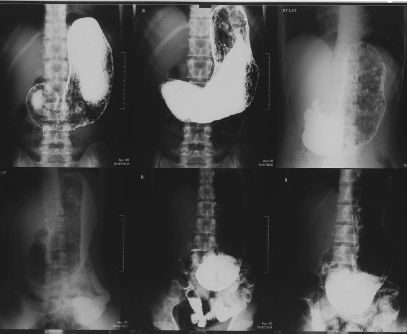 Гастроптоз на контрастной рентгенограмме