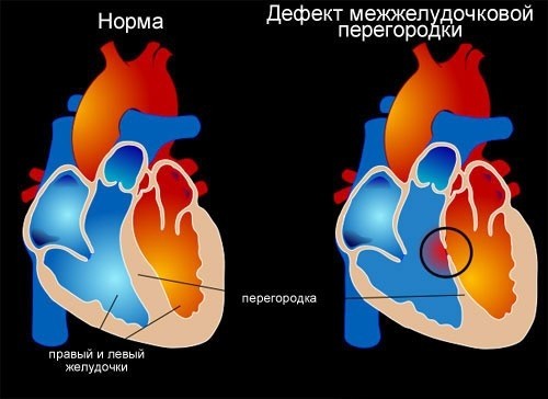 Наличие дефекта между правым и левым желудочками сердца.
