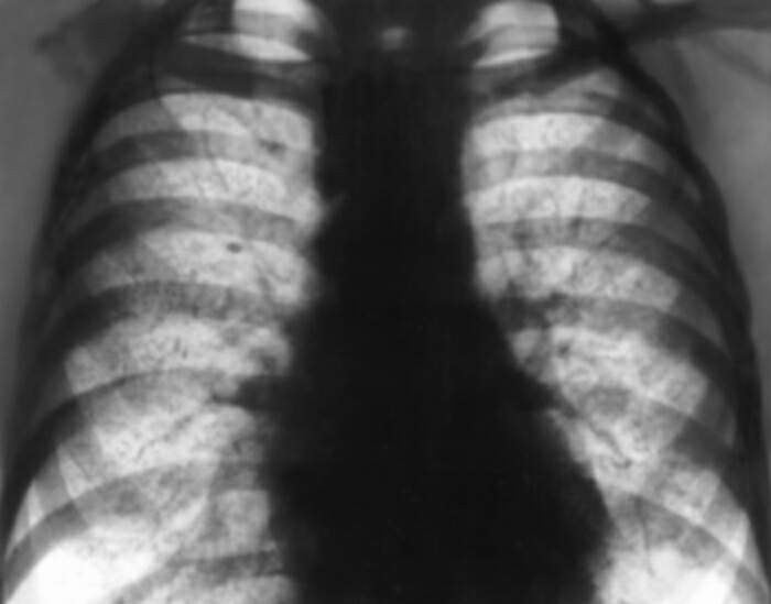 Рентгенограмма органов грудной клетки при идиопатическом гемосидерозе легких