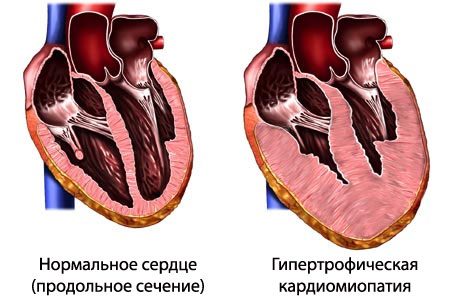 Гипертрофическая кардиомиопатия на рисунке справа