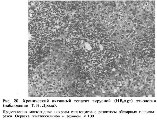 Хронический активный гепатит вирусной этиологии (гистологический препарат)