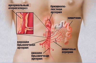 Код мкб болезни кишечника thumbnail