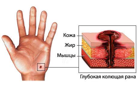 Схематическое изображение колотой раны