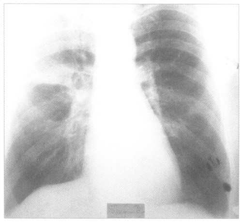 Крупозная пневмония на рентгенснимке