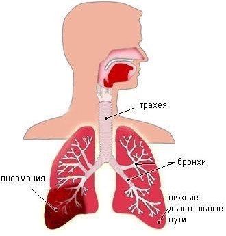Код мкб долевая пневмония