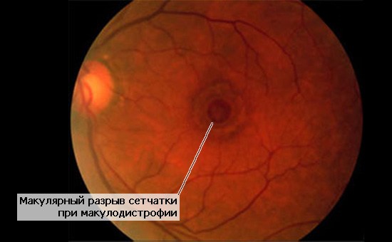 Макулярный разрыв сетчатки при макулодистрофии (осмотр глазного дна)