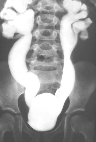 Мегауретер (рентгенконстрастный снимок)