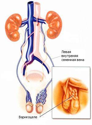 Варикоцеле - одна из причин развития мужского бесплодия