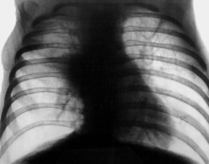 Рентгенограмма органов грудной клетки при муковисцидозе (ребенок,7 лет)