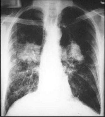 Рентгенография органов грудной клетки при муковисцидозе легких