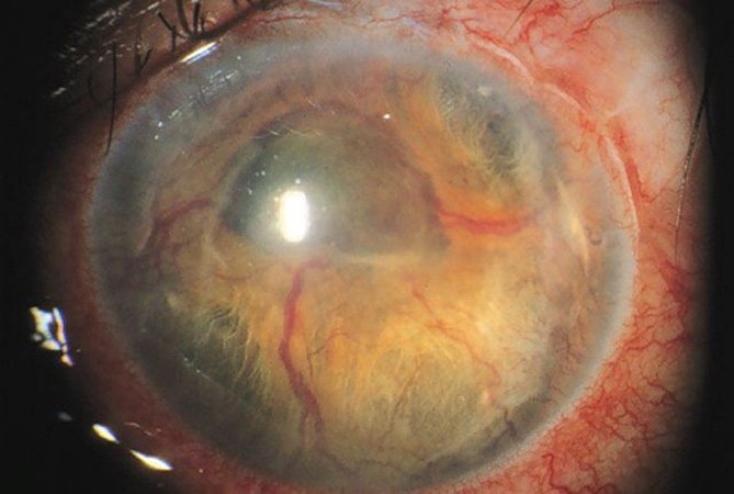 Неоваскулярная глаукома пр осмотре глазного дна